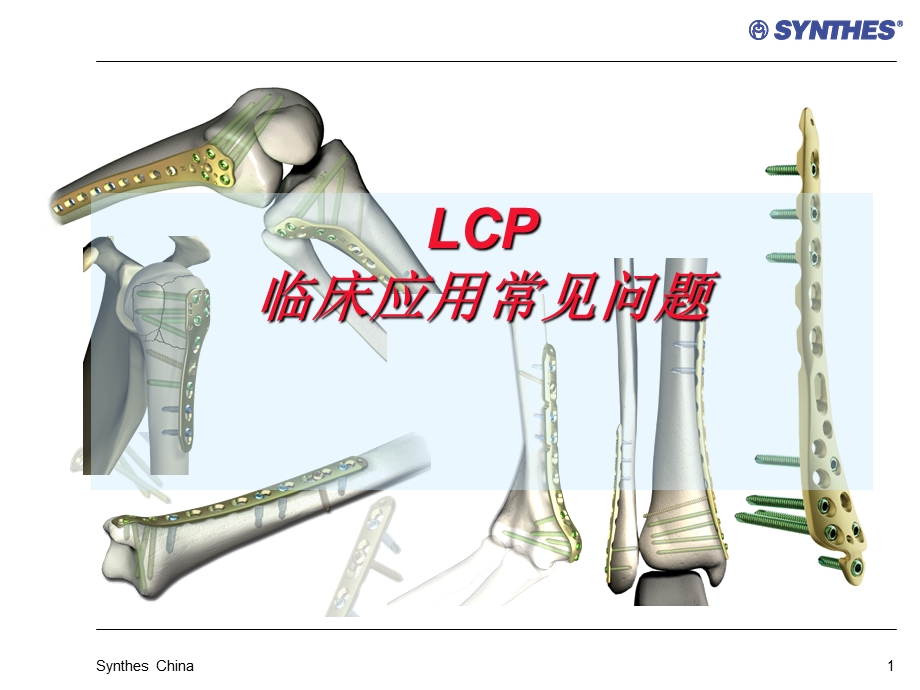 锁定内固定系统临床应用常见问题LCPQuestionsppt课件.ppt_第1页