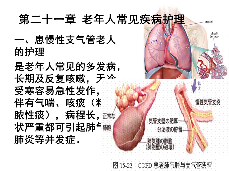 第二十一章老年人常见疾病的护理ppt课件.ppt_第2页