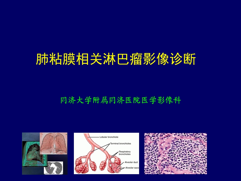 肺粘膜相关淋巴瘤影像特征ppt课件.pptx_第1页