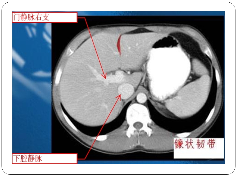 腹部CT示意图及超详细教程ppt课件.ppt_第3页