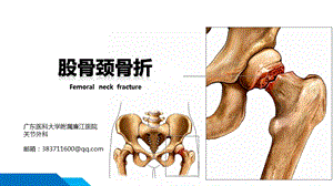 股骨颈骨折ppt课件.pptx