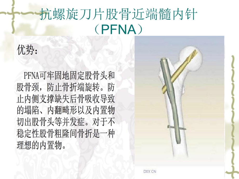 股骨粗隆间骨折手术配合ppt课件.ppt_第2页