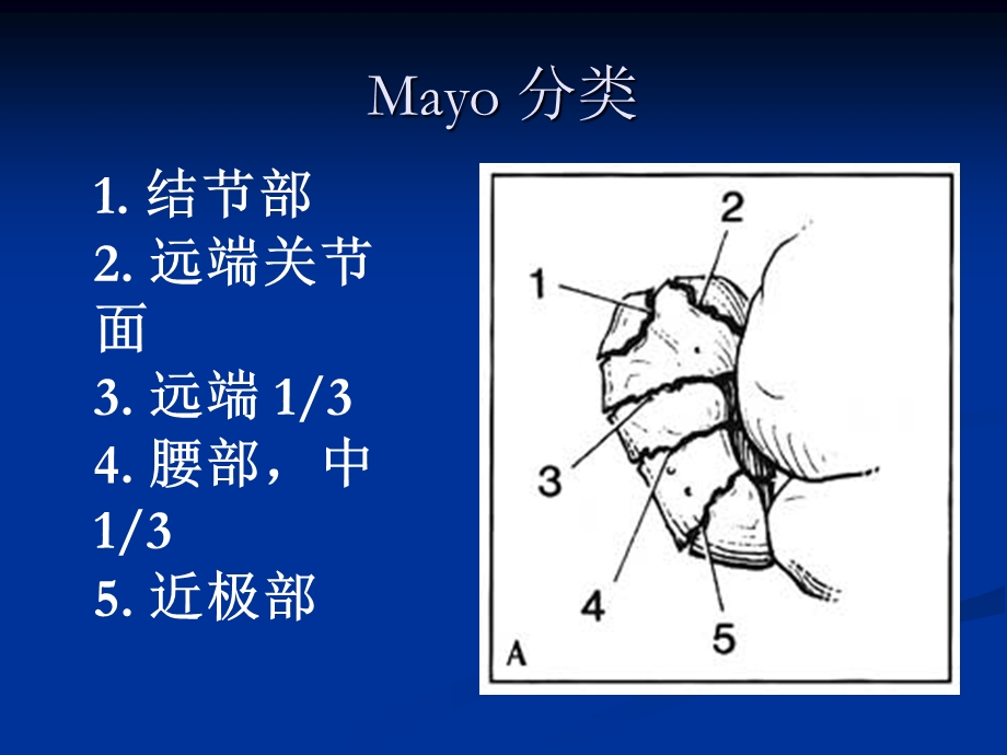 腕部舟状骨骨折ppt课件.ppt_第3页