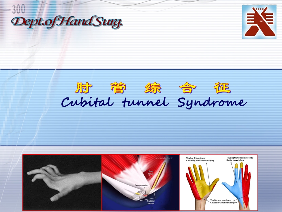 肘管综合症ppt课件.pptx_第1页