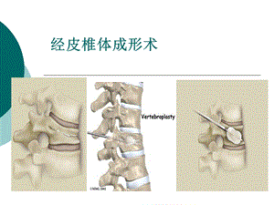 范小春经皮椎体后凸成形术ppt课件.ppt