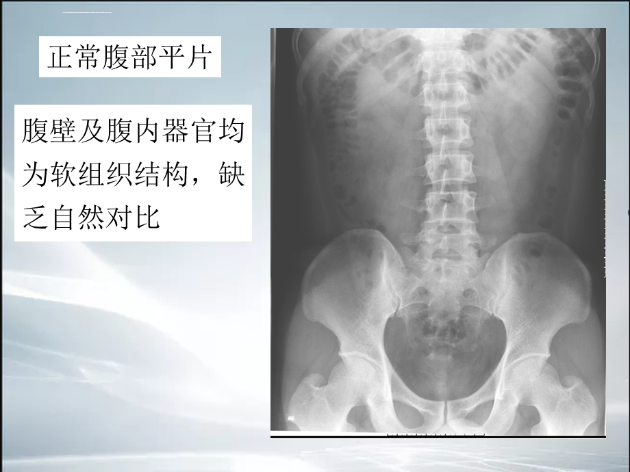 肠梗阻的X线表现ppt课件.ppt_第3页