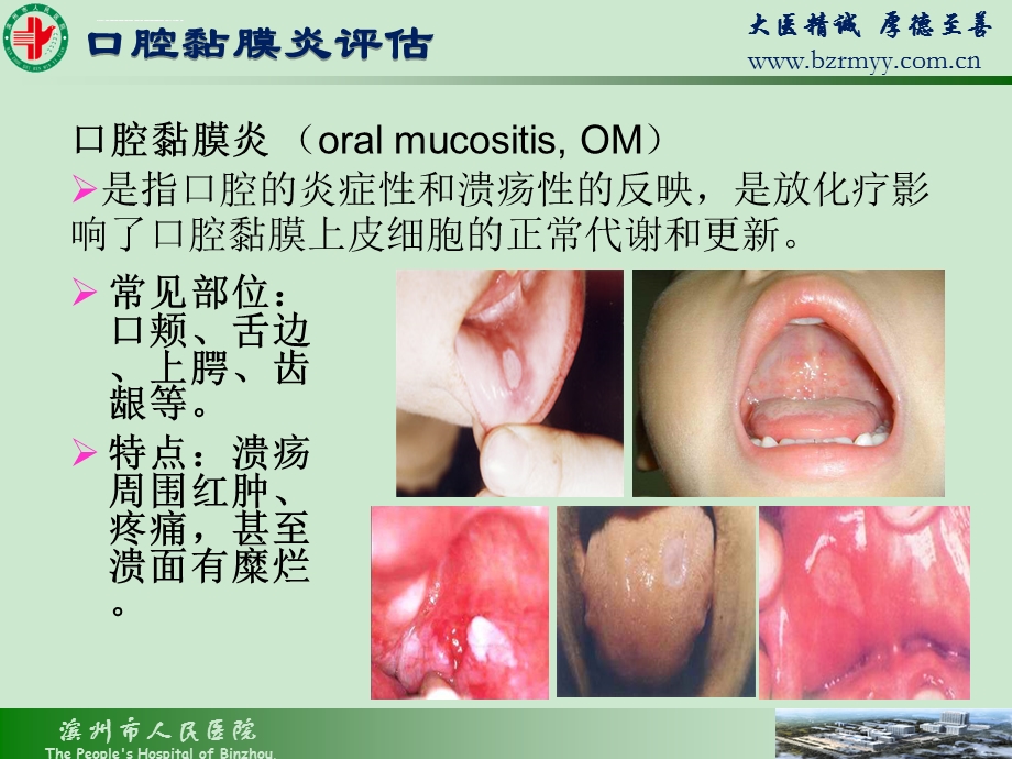 肿瘤患者口腔黏膜炎风险评估与防范ppt课件.ppt_第3页