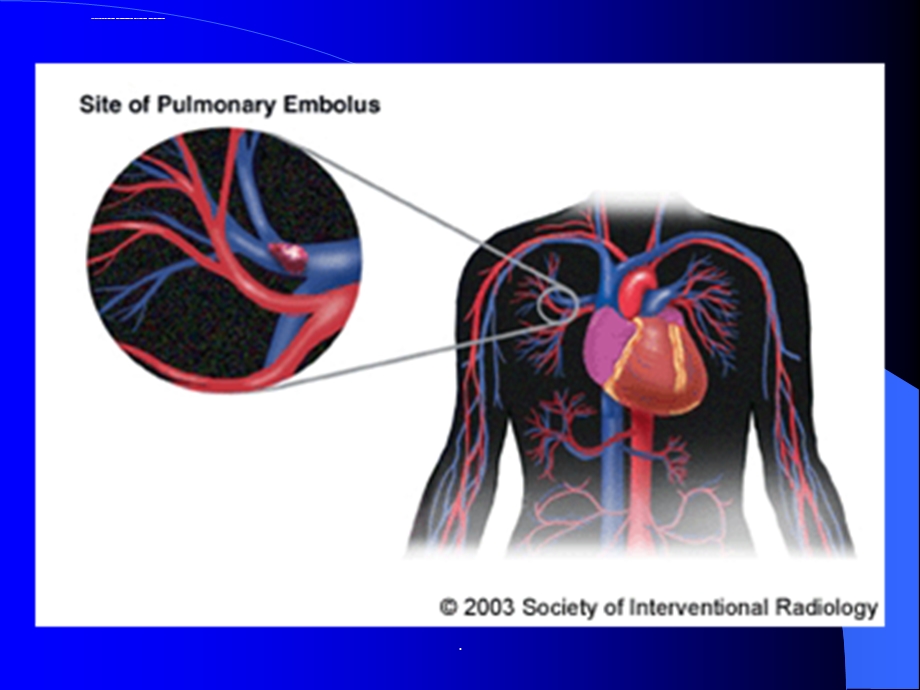 肺栓塞护理查房(精)ppt课件.ppt_第3页