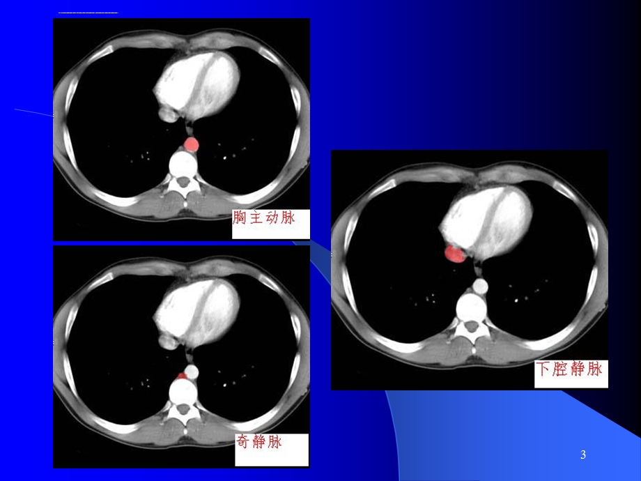腹部CT诊断(很经典)ppt课件.ppt_第3页