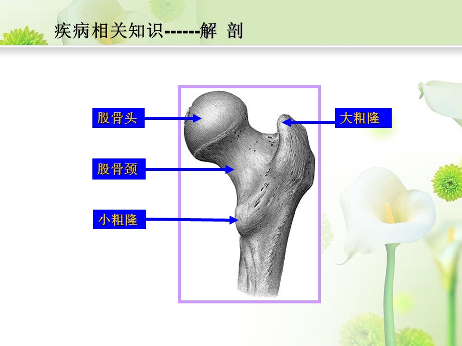 股骨粗隆间骨折护理查房ppt课件.ppt_第3页