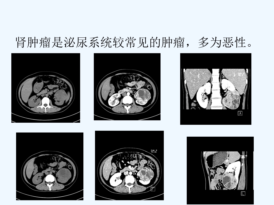 肾癌CT诊断与鉴别诊断ppt课件.ppt_第1页