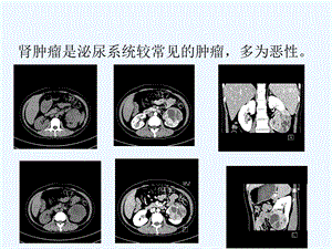 肾癌CT诊断与鉴别诊断ppt课件.ppt