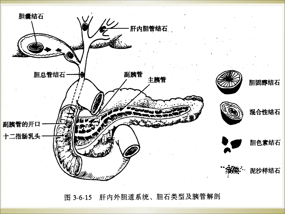 胆道感染与胆石症病人的护理ppt课件.ppt_第3页