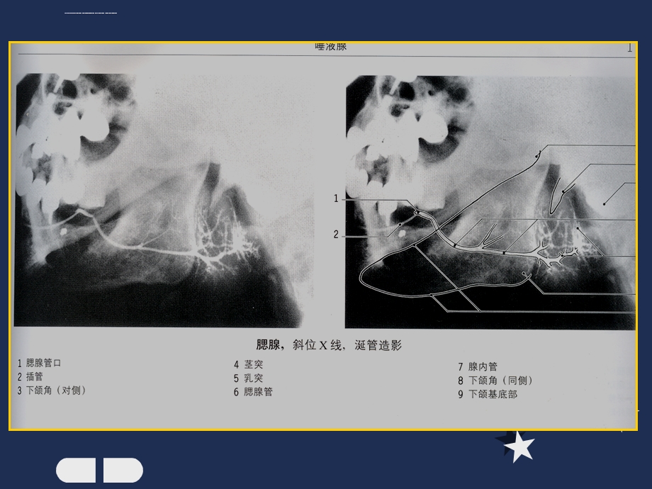 腮腺疾病的影像诊断ppt课件.ppt_第3页