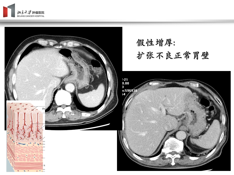 胃癌影像诊断ppt课件.ppt_第3页