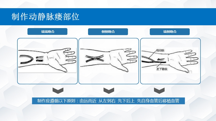 自体动静脉内瘘的护理常规ppt课件.pptx_第3页