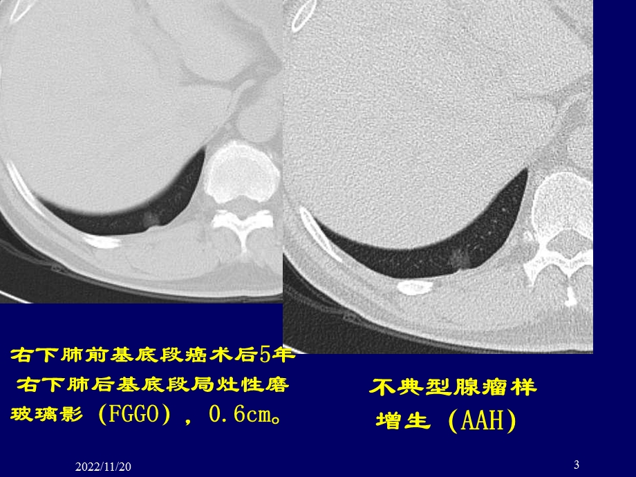 肺部结节的CT鉴别诊断ppt课件.ppt_第3页