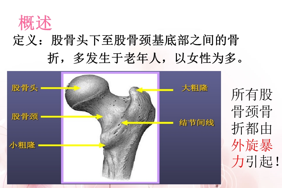 股骨颈骨折护理查房ppt课件.ppt_第2页