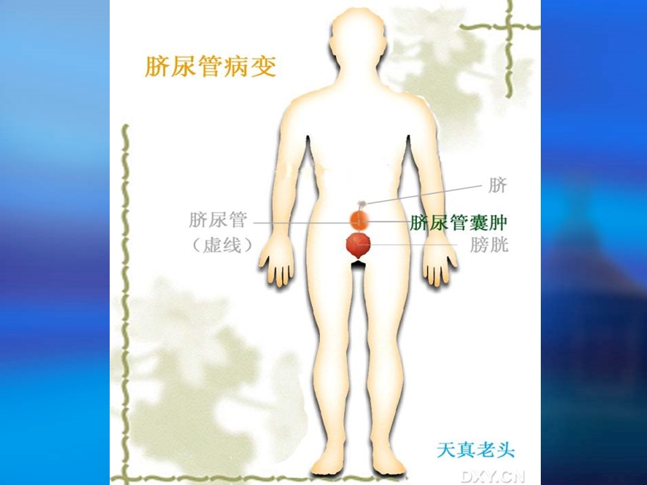 脐尿管疾病的超声诊断ppt课件.ppt_第3页