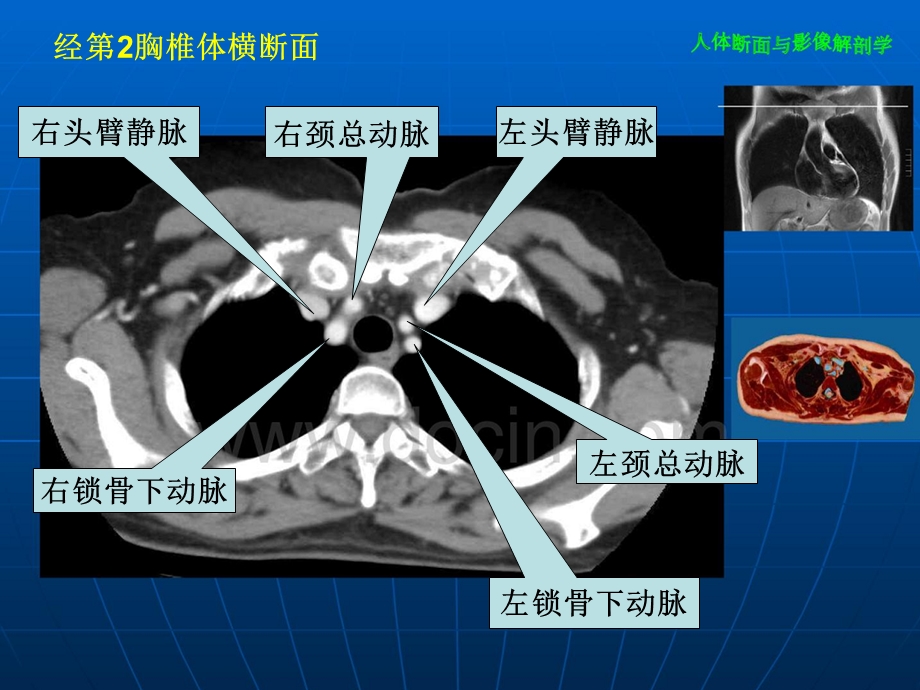 胸部CT全部介绍ppt课件.ppt_第2页