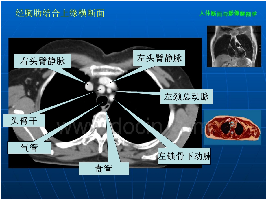 胸部CT全部介绍ppt课件.ppt_第3页