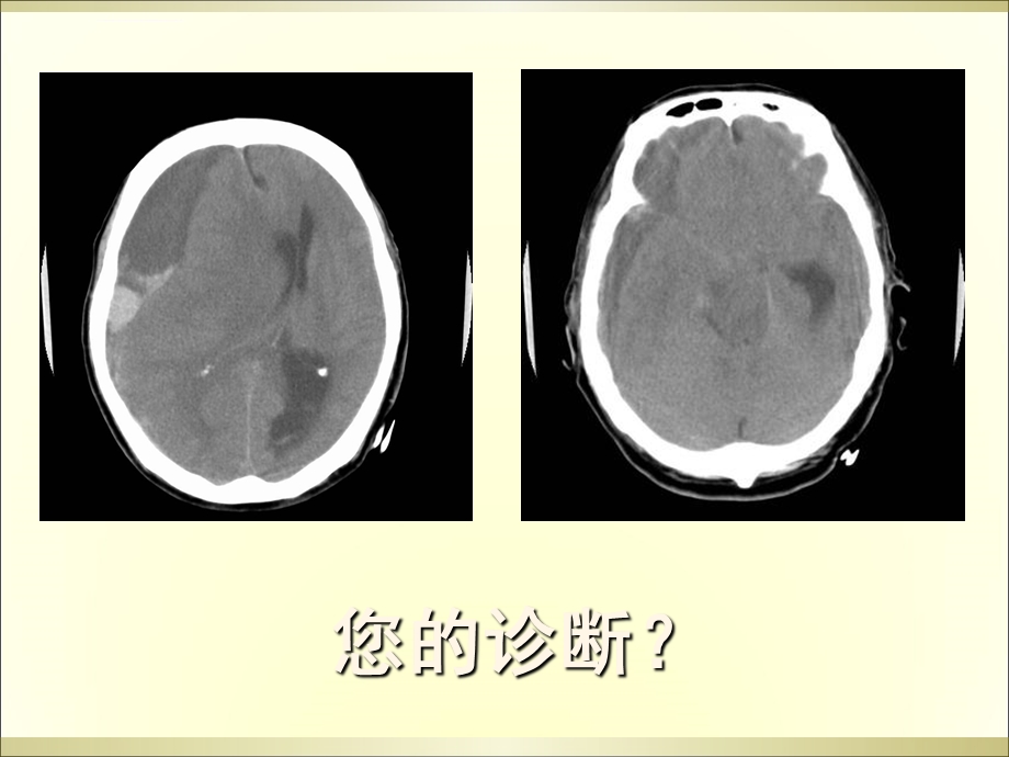 脑疝的分类及影像表现ppt课件.ppt_第2页