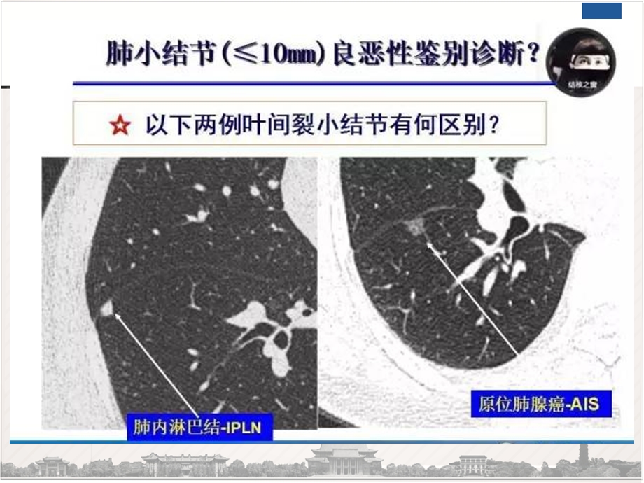 肺内淋巴结的CT表现与鉴别诊断ppt课件.pptx_第2页