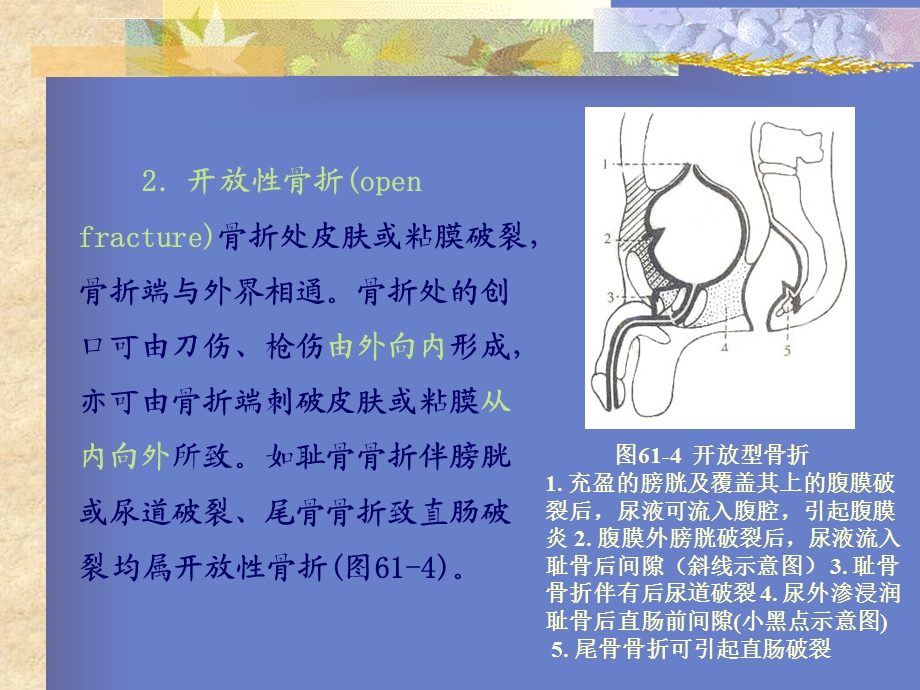 骨折的分类ppt课件.ppt_第3页