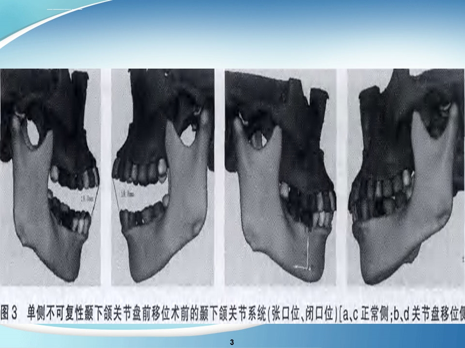 颞颌关节手术简介ppt课件.ppt_第3页