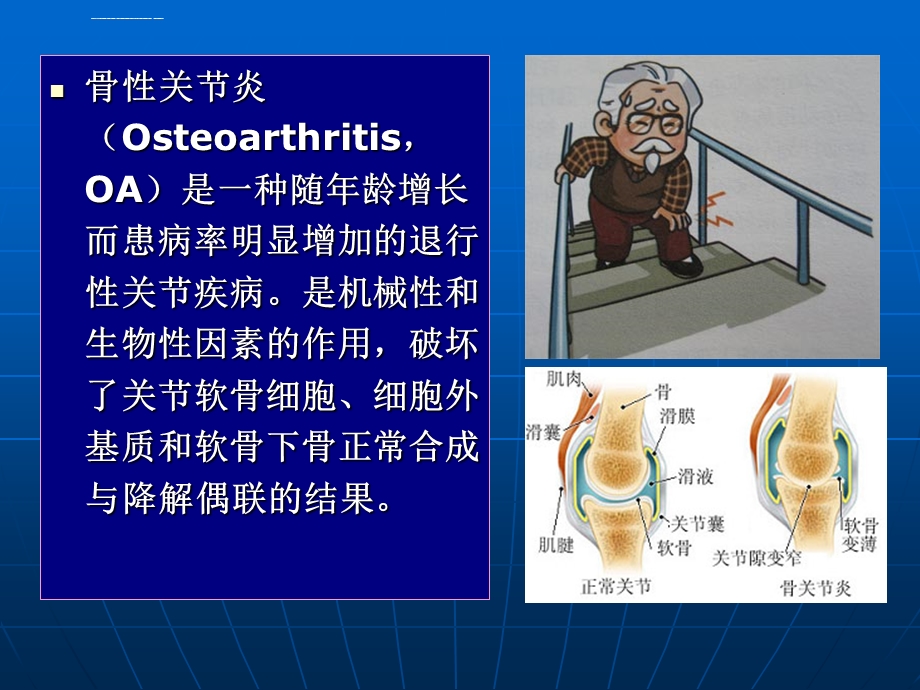 膝关节骨性关节炎的诊断及治疗ppt课件.ppt_第2页