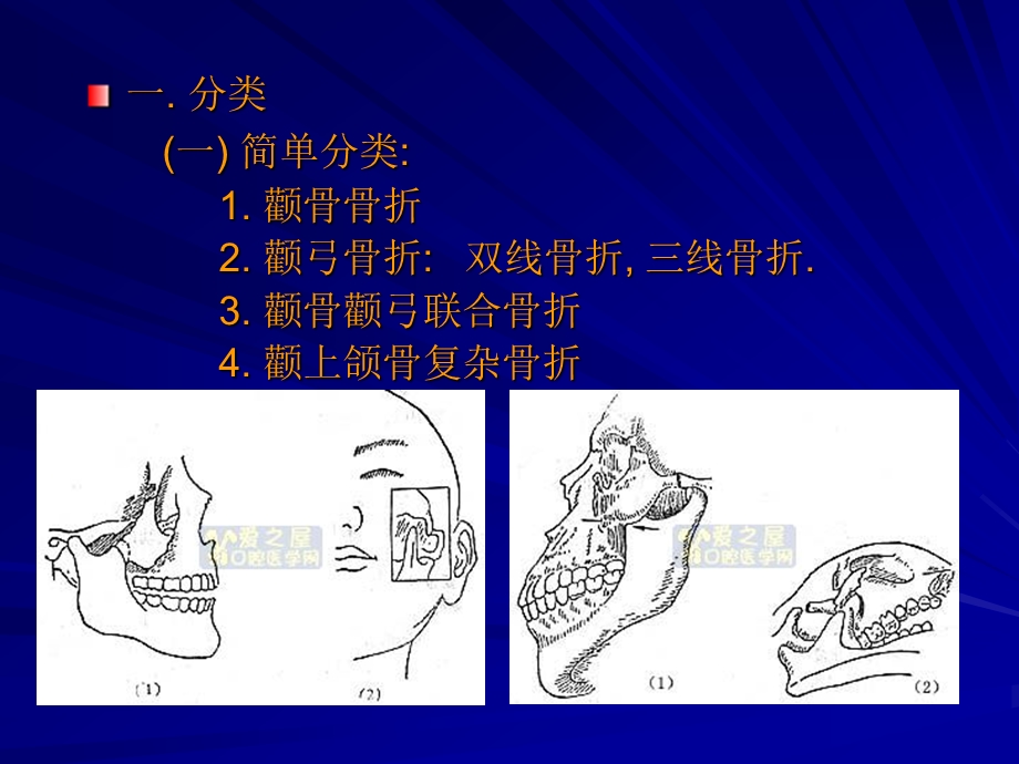 颧骨颧弓骨折ppt课件.ppt_第3页