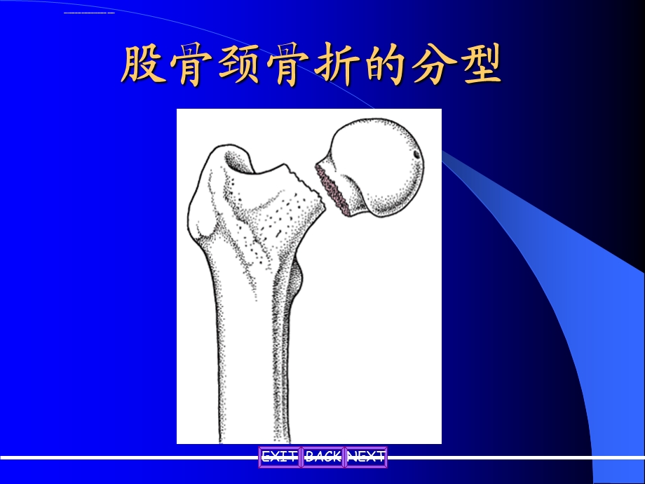 髋部骨折的分型ppt课件.ppt_第3页