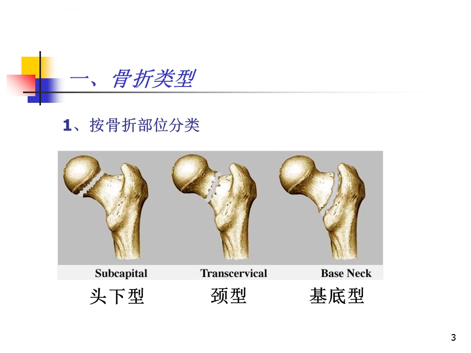 股骨颈骨折的护理PPT课件.ppt_第3页