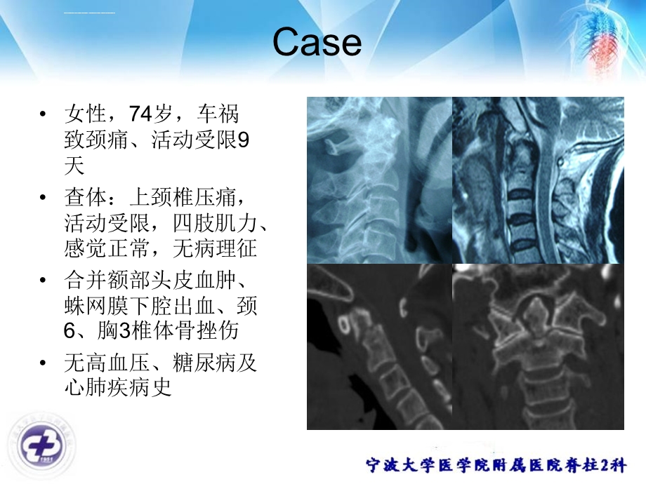 齿状突骨折ppt课件.ppt_第2页