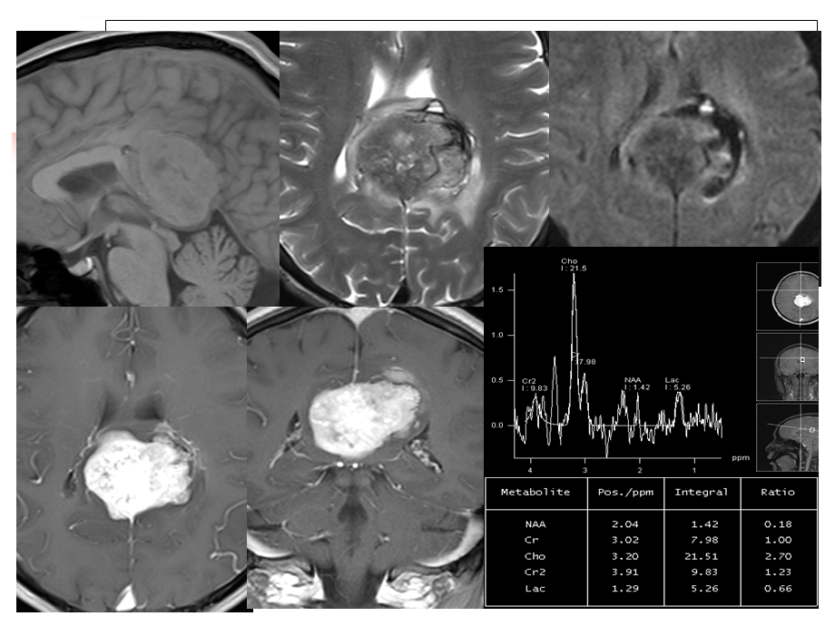 颅内孤立性纤维瘤MRI表现ppt课件.ppt_第2页