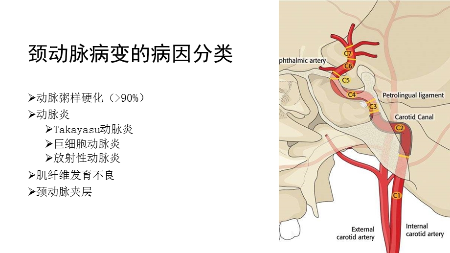 颈动脉粥样硬化的诊治ppt课件.pptx_第2页