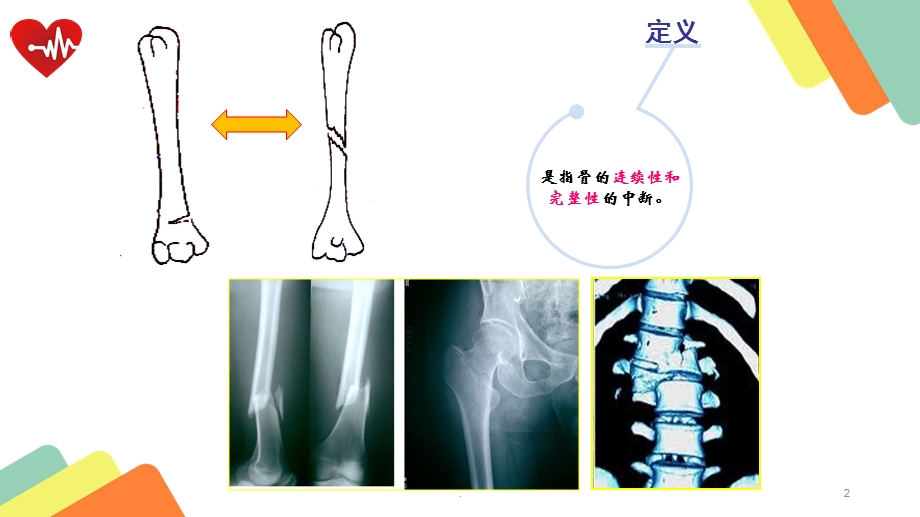 骨折病人的护理ppt教学课件.pptx_第2页