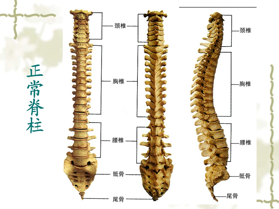 脊柱侧弯病人的护理ppt课件.ppt_第2页