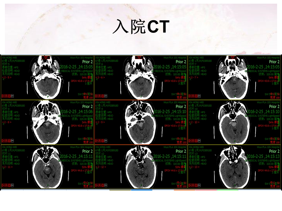 脑干出血治疗体会ppt课件.ppt_第3页