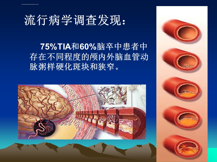 颈动脉狭窄介入治疗ppt课件.ppt_第2页