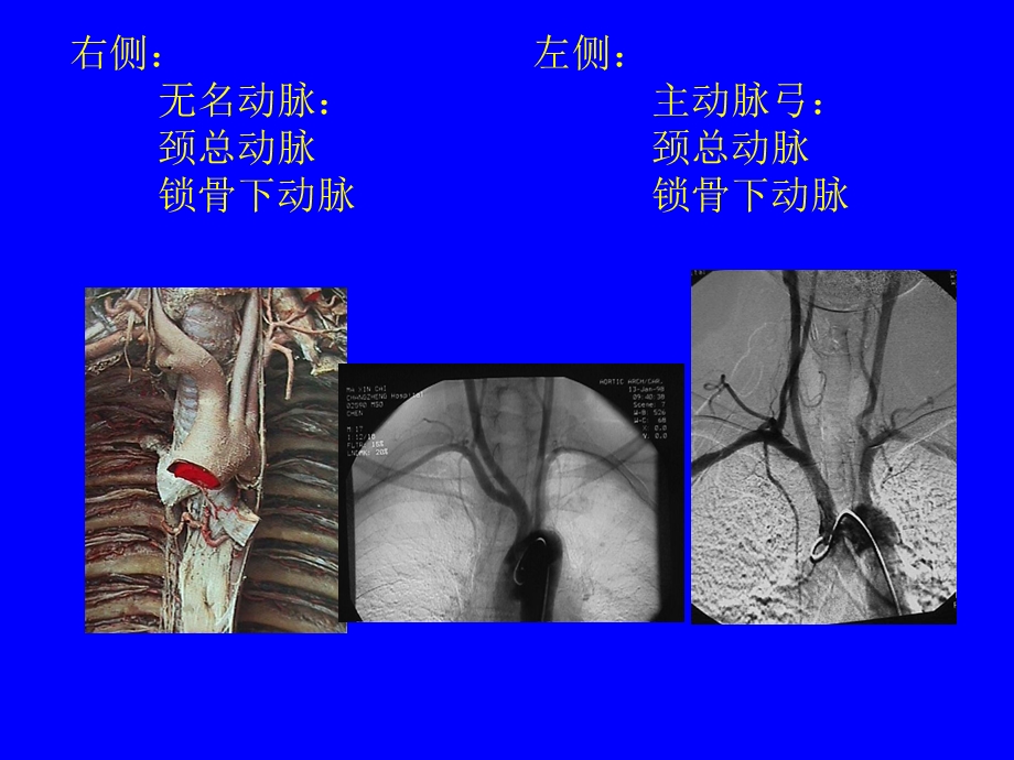 颈内动脉解剖ppt课件.ppt_第3页