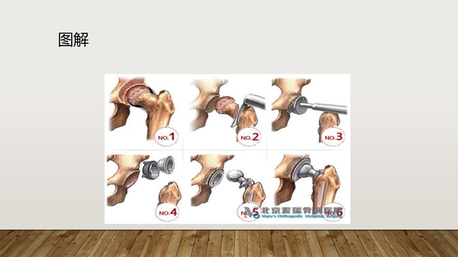 髋关节置换术后康复PPT课件.ppt_第3页