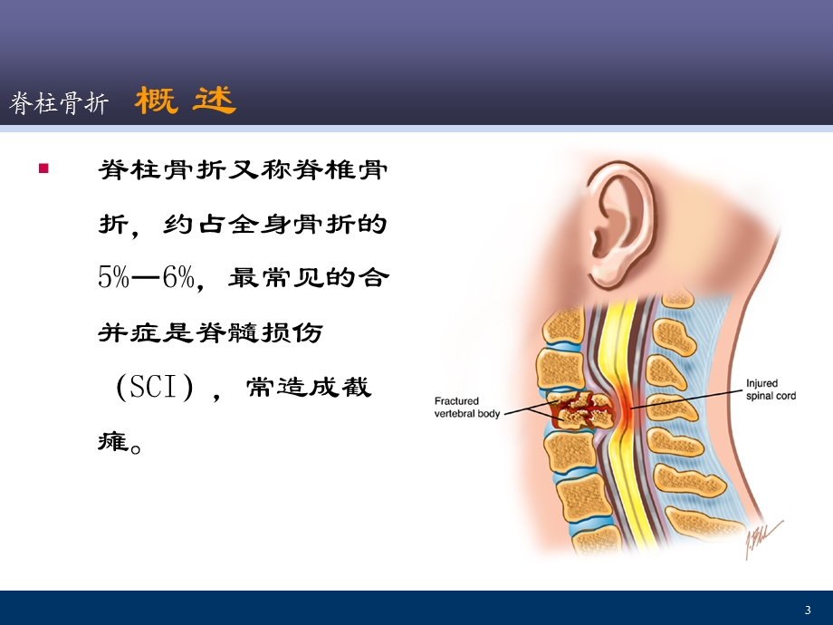 脊柱骨折ppt课件.ppt_第3页