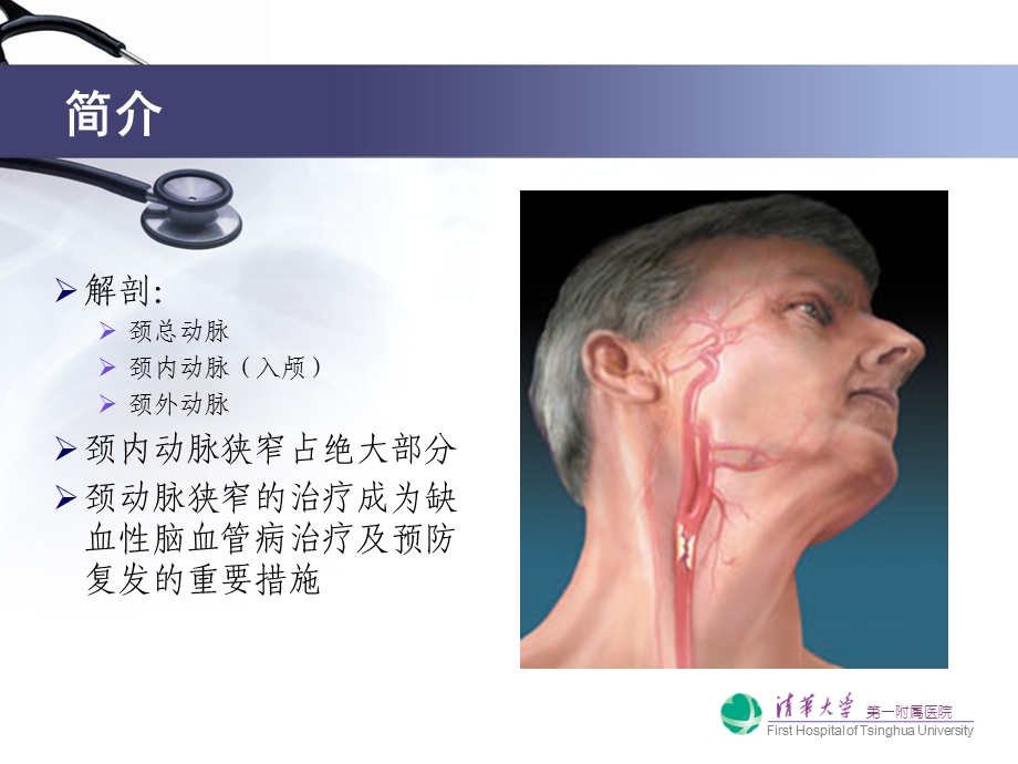 颈动脉狭窄的诊断治疗ppt课件.ppt_第2页