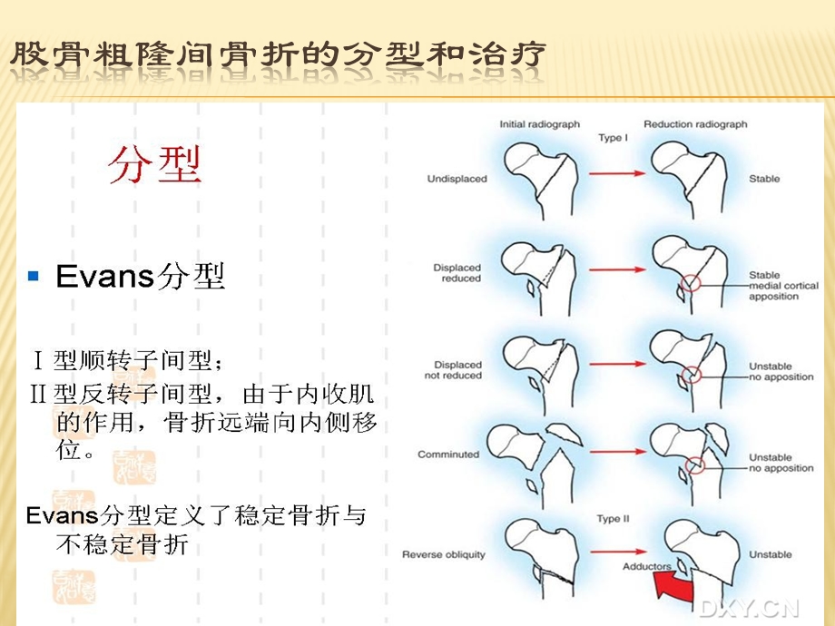 股骨粗隆间骨折分型和治疗ppt课件.pptx_第2页