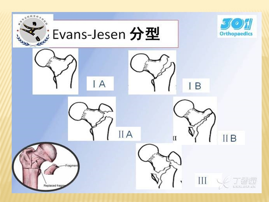 股骨粗隆间骨折分型和治疗ppt课件.pptx_第3页