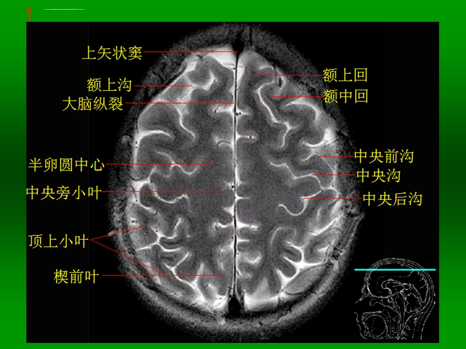 颅脑MRI断层解剖和影像ppt课件.ppt_第2页