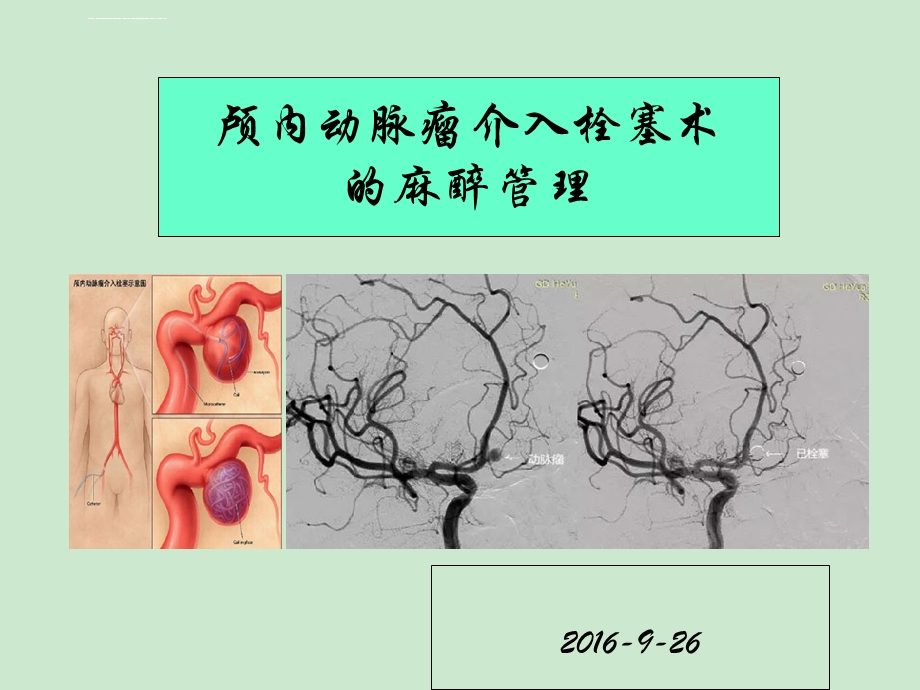 颅内动脉瘤介入栓塞术的麻醉管理ppt课件.ppt_第1页