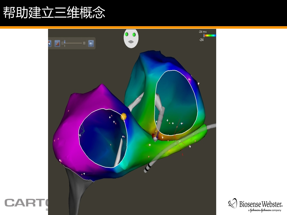 CARTO3在室上速中的应用ppt课件.ppt_第3页