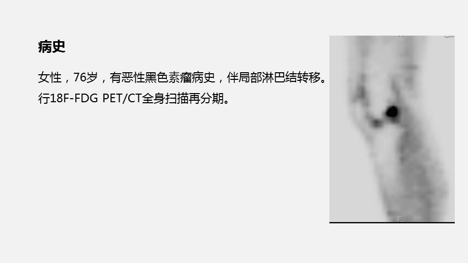 PET之膝关节骨性关节炎影像学病例ppt课件.pptx_第2页